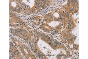 Immunohistochemistry of Human gastric cancer using CDK11A/CDK11B Polyclonal Antibody at dilution of 1:40 (CDK11 抗体)