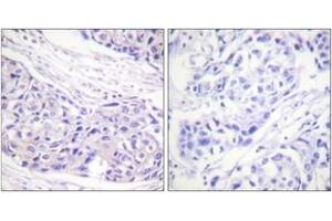 Immunohistochemistry analysis of paraffin-embedded human breast carcinoma tissue, using p90 RSK (Ab-359/363) Antibody. (RPS6KA3 抗体  (AA 331-380))