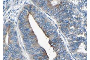 ABIN6267435 at 1/100 staining human Thyroid cancer tissue sections by IHC-P.