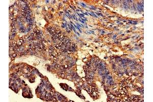 Immunohistochemistry of paraffin-embedded human colon cancer using ABIN7147936 at dilution of 1:100 (CLASP2 抗体  (AA 226-381))