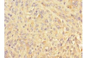 Immunohistochemistry of paraffin-embedded human melanoma using ABIN7151102 at dilution of 1:100 (Pellino 3 抗体  (AA 1-280))
