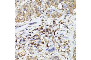 Immunohistochemistry of paraffin-embedded human esophageal cancer using ASC/TMS1 Rabbit pAb (ABIN7269756) at dilution of 1:200 (40x lens). (PYCARD 抗体)