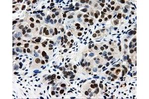Immunohistochemical staining of paraffin-embedded Adenocarcinoma of breast tissue using anti-CISD1 mouse monoclonal antibody. (CISD1 抗体)