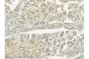 ABIN6257324 and ABIN6273467 at 1/100 staining human lung squamous cell carcinoma by IHC-P. (MLF1IP 抗体  (N-Term))
