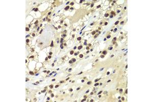Immunohistochemistry of paraffin-embedded human kidney cancer using PRKDC antibody (ABIN5975861) at dilution of 1/100 (40x lens). (PRKDC 抗体)