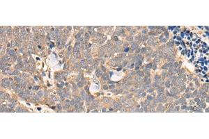 Immunohistochemistry of paraffin-embedded Human thyroid cancer tissue using NCAPH Polyclonal Antibody at dilution of 1:45(x200) (NCAPH 抗体)