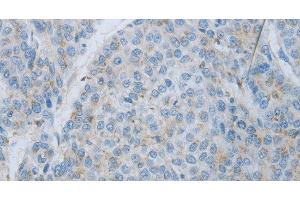Immunohistochemistry of paraffin-embedded Human liver cancer using MMP25 Polyclonal Antibody at dilution of 1:80 (MMP25 抗体)