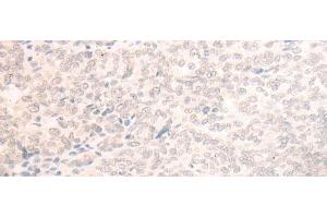 Immunohistochemistry of paraffin-embedded Human ovarian cancer tissue using EME2 Polyclonal Antibody at dilution of 1:40(x200) (EME2 抗体)