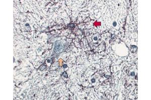 Formalin-fixed, paraffin embedded section of human brain stained for GFAP (clone 4A11, ABIN967499) using a DAB chromogen and hematoxylin counterstain. (GFAP 抗体)