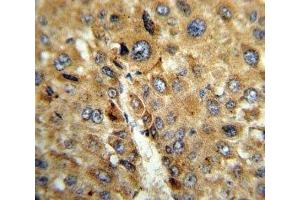 IHC analysis of FFPE human hepatocarcinoma stained with TAT antibody (Tat (AA 279-306) 抗体)