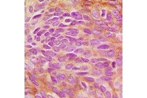 Immunohistochemical analysis of ERK5 staining in human breast cancer formalin fixed paraffin embedded tissue section. (MAPK7 抗体)