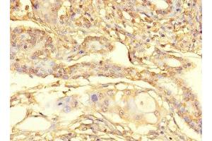 Immunohistochemistry of paraffin-embedded human pancreatic cancer using ABIN7166432 at dilution of 1:100 (METTL21C 抗体  (AA 6-145))