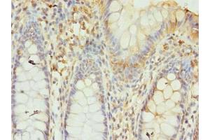 Immunohistochemistry of paraffin-embedded human colon cancer using ABIN7153785 at dilution of 1:100 (GTF3C6 抗体  (AA 2-213))