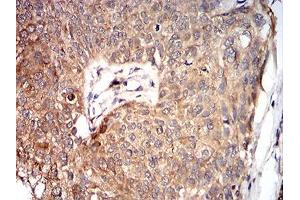 Immunohistochemical analysis of paraffin-embedded bladder cancer tissues using VP2 mouse mAb with DAB staining. (VP2 (AA 296-438) 抗体)
