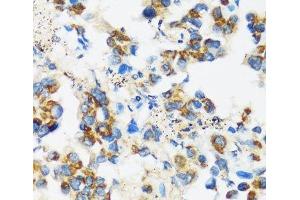 Immunohistochemistry of paraffin-embedded Human lung cancer using APOBEC3F Polyclonal Antibody at dilution of 1:100 (40x lens). (APOBEC3F 抗体)