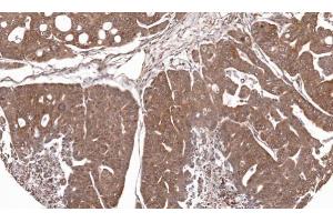 IHC-P Image Immunohistochemical analysis of paraffin-embedded Gastric CA N87 xenograft, using RPL5, antibody at 1:100 dilution. (RPL5 抗体)