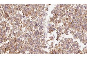 ABIN6278899 at 1/100 staining Human Melanoma tissue by IHC-P. (IL-3 抗体  (Internal Region))