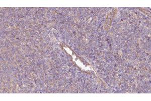 ABIN6273064 at 1/100 staining Human lymph cancer tissue by IHC-P. (PHGDH 抗体  (N-Term))