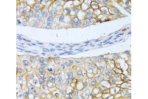 Immunohistochemistry of paraffin-embedded Human prostate cancer using BMP4 Polyclonal Antibody at dilution of 1:100 (40x lens). (BMP4 抗体)