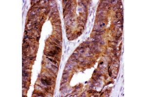 Anti- FOXO3A antibody,IHC(P) IHC(P): Human Intestinal Cancer Tissue (FOXO3 抗体  (AA 471-673))
