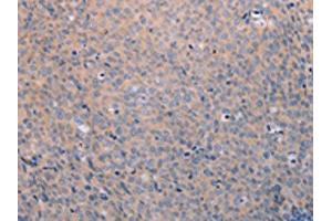 The image on the left is immunohistochemistry of paraffin-embedded Human cervical cancer tissue using ABIN7189808(ANKRD26 Antibody) at dilution 1/25, on the right is treated with synthetic peptide. (ANKRD26 抗体)