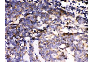 Anti- MAPK6 Picoband antibody, IHC(P) IHC(P): Human Lung Cancer Tissue (MAPK6 抗体  (AA 520-721))
