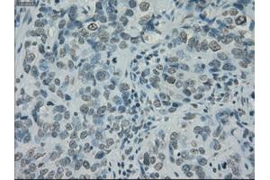 Immunohistochemical staining of paraffin-embedded Carcinoma of thyroid tissue using anti-PRKYmouse monoclonal antibody. (PRKY 抗体)