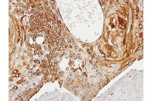 IHC-P Image Immunohistochemical analysis of paraffin-embedded HSC3 xenograft, using Creatine kinase (brain), antibody at 1:100 dilution. (CKB 抗体)