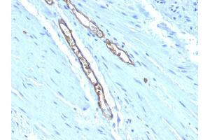 Formalin-fixed, paraffin-embedded human Colon Carcinoma stained with Blood Group Antigen A Monoclonal Antibody (HE-193) (ABO 抗体)