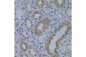Immunohistochemistry of paraffin-embedded human kidney cancer using MVP Antibody (ABIN1873787) at dilution of 1:200 (40x lens).