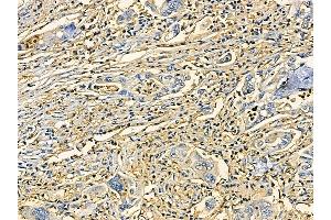 ABIN7095445 and ABIN7099502 at 1/100 staining human gastric cancer by IHC-P.