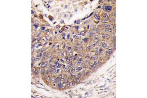 Formalin-fixed and paraffin-embedded human lung carcinoma tissue reacted with FXN antibody , which was peroxidase-conjugated to the secondary antibody, followed by DAB staining. (Frataxin 抗体  (C-Term))
