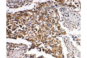 IHC-P: SMAD5 antibody testing of human lung cancer tissue