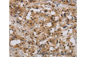 Immunohistochemistry of Human liver cancer using E2F4 Polyclonal Antibody at dilution of 1:40 (E2F4 抗体)