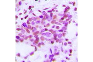 Immunohistochemical analysis of Hexokinase 1 staining in human breast cancer formalin fixed paraffin embedded tissue section. (Hexokinase 1 抗体  (N-Term))