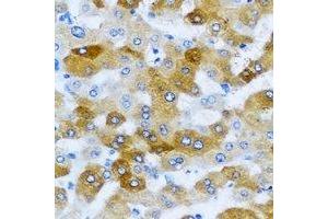 Immunohistochemical analysis of KLK10 staining in human liver cancer formalin fixed paraffin embedded tissue section. (Kallikrein 10 抗体)