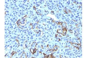 Formalin-fixed, paraffin-embedded human Melanoma stained with NGFR Monoclonal Antibody (NGFR5 + NTR/912). (NGFR 抗体)