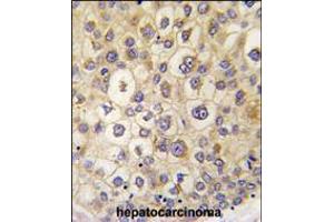 Formalin-fixed and paraffin-embedded human hepatocarcinoma tissue reacted with ARHE antibody , which was peroxidase-conjugated to the secondary antibody, followed by DAB staining. (RND3 抗体  (AA 133-165))