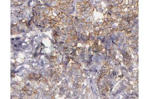 ABIN6268685 at 1/100 staining human lung carcinoma tissue sections by IHC-P. (CD9 抗体  (Internal Region))