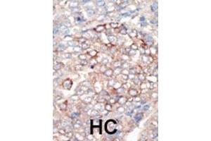 Formalin-fixed and paraffin-embedded human cancer tissue reacted with the primary antibody, which was peroxidase-conjugated to the secondary antibody, followed by DAB staining. (PIK3R4 抗体  (N-Term))