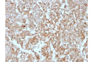Formalin-fixed, paraffin-embedded human GIST stained with DOG-1 Mouse Recombinant Monoclonal Antibody (rDG1/447). (Recombinant ANO1 抗体)