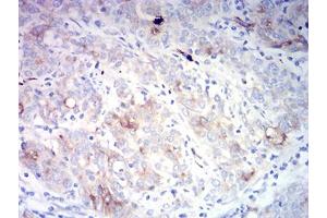Immunohistochemical analysis of paraffin-embedded cervical cancer tissues using CD66A mouse mAb with DAB staining.