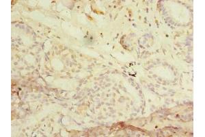 Immunohistochemistry of paraffin-embedded human breast cancer using ABIN7168022 at dilution of 1:100 (RHOC 抗体  (AA 1-190))