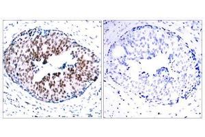 Immunohistochemical analysis of paraffin- embedded human breast carcinoma tissue using STAT5A (phospho-Ser780) antibody (E011049). (STAT5A 抗体  (pSer780))