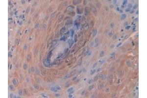 Detection of CD63 in Human Skin cancer Tissue using Polyclonal Antibody to Tetraspanin 30Cluster of Differentiation 63 (CD63) (CD63 抗体  (AA 103-203))