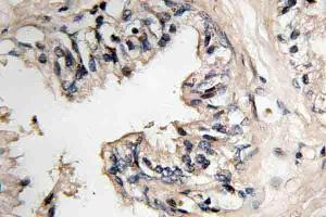 Immunohistochemistry (IHC) analyzes of MRP-S36 antibody in paraffin-embedded human prostate carcinoma tissue. (MRPS36 抗体)