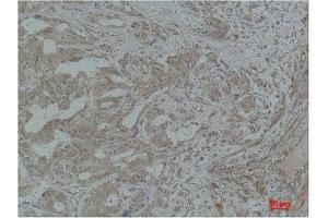 Immunohistochemistry (IHC) analysis of paraffin-embedded Human Breast Carcinoma using Stat3 Polyclonal Antibody. (STAT3 抗体)