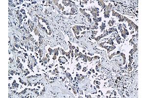 Formalin-fixed and paraffin embedded rat differentiated adenocarcinoma labeled with Anti ESAM Polyclonal Antibody, Unconjugated (ABIN758621) at 1:200 followed by conjugation to the secondary antibody and DAB staining (ESAM 抗体  (AA 21-120))