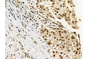 Phospho-p53 (Ser33) Antibody at 1/100 staining Human ovarian cancer by IHC-P. (p53 抗体  (pSer33))