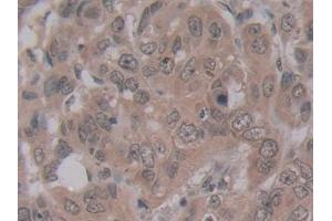 Detection of ENPP2 in Human Breast cancer Tissue using Monoclonal Antibody to Ectonucleotide Pyrophosphatase/Phosphodiesterase 2 (ENPP2) (ENPP2 抗体  (AA 637-905))